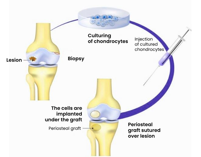 Joint replacement surgery