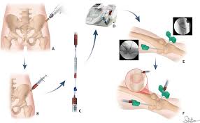 Total joint replacement