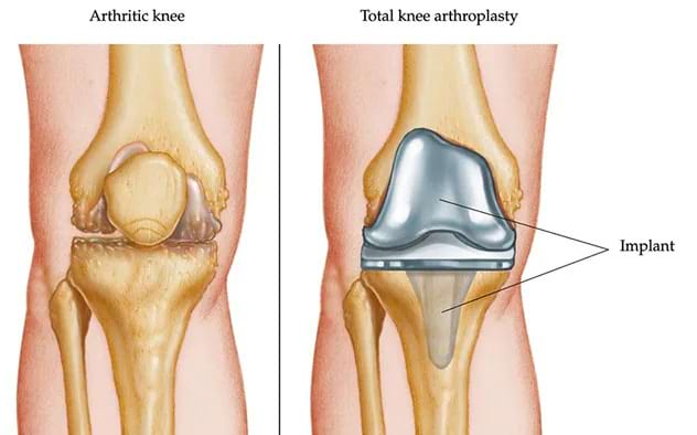 Knee arthroplasty